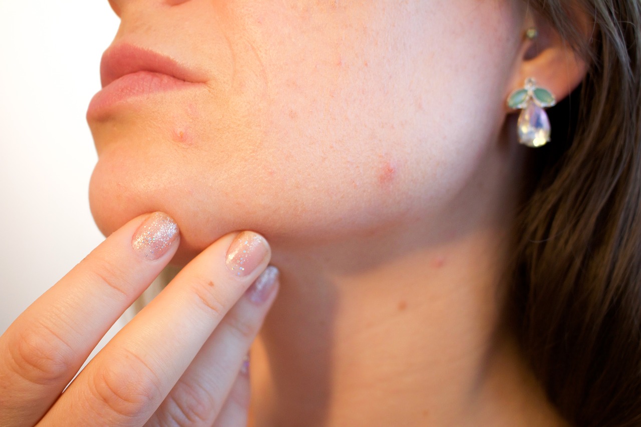 Top Home Remedies To Get Rid of Acne According To Your Skin Type