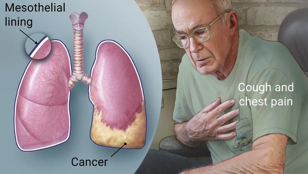 mesothelioma