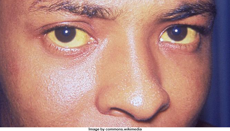 Home Remedies For Jaundice In Adults