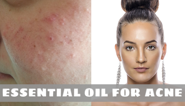 Best Essential Oils For Acne And How To Use Them