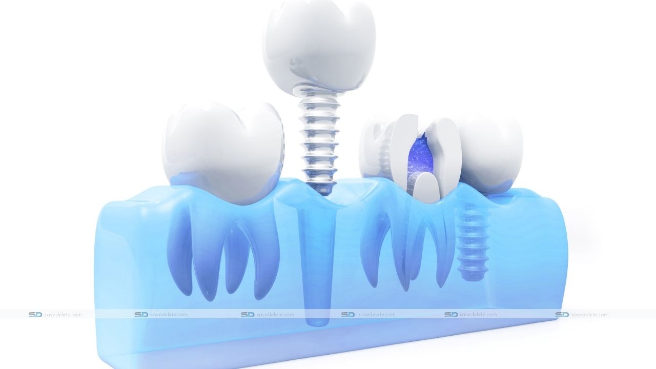 dental implants