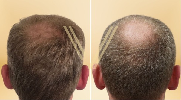 Hair Transplant